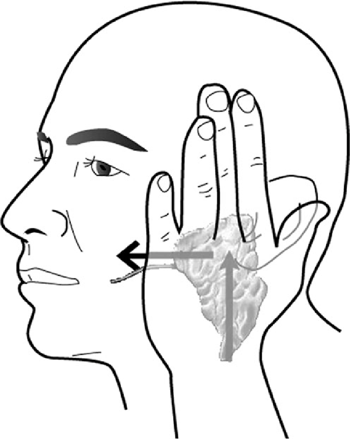 714x896 Demonstrating The Parotid Gland (Pg) Massage Method Used (3).