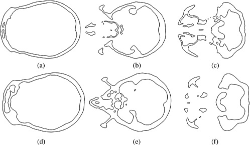 498x290 Von Mises Stress Contours For A Molar Bite For The Range [0,8] Mpa