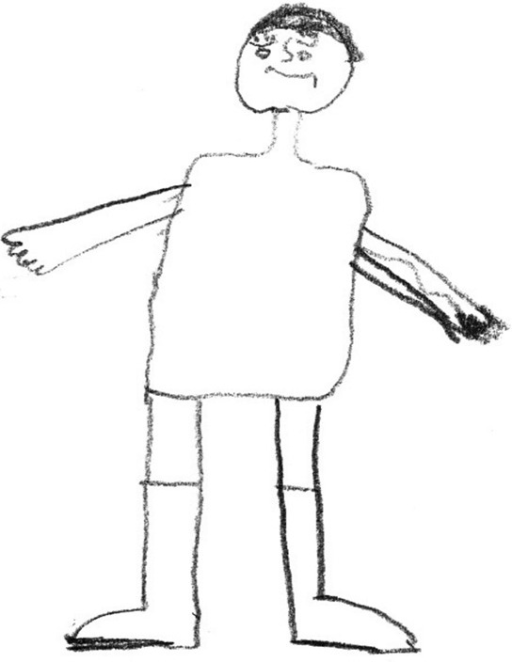 512x662 Drawing Of A Child With Duchenne Muscular Dystrophy (Dr Open I