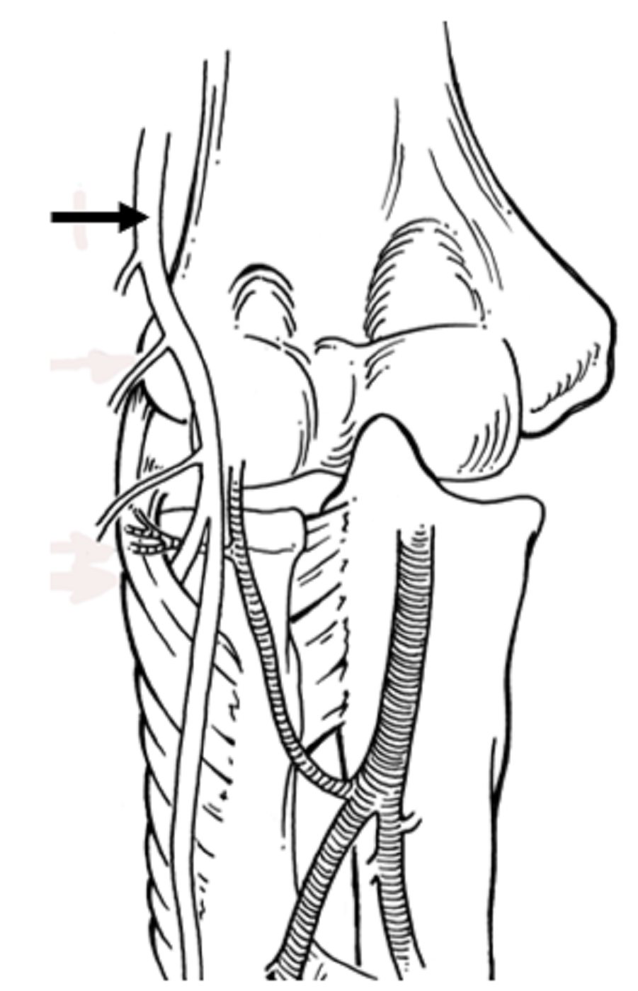 901x1398 Cureus Injury Of The Radial Nerve In The Arm A Review