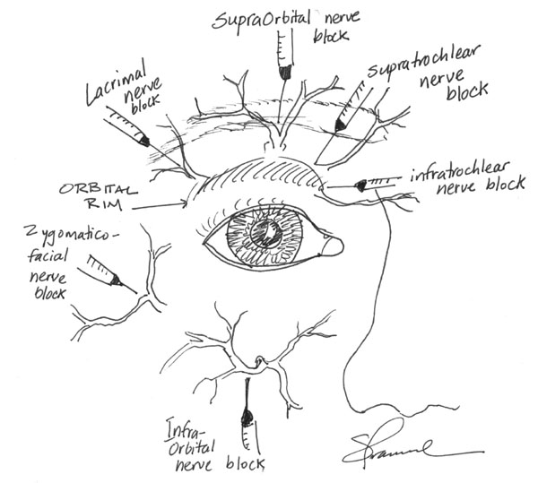 600x539 Doctors Gates Common Nerve Blocks Used By Ophthalmologists