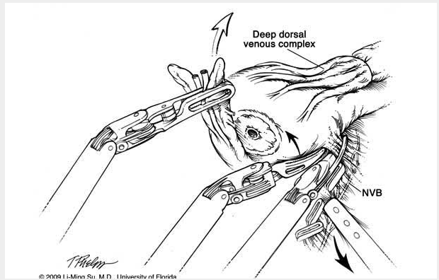 620x396 Robotic Nerve Sparing Radical Prostatectomy Department