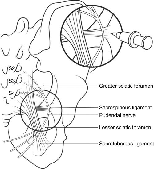 500x551 Schematic Drawing Of The Tract Of The Pudendal Nerve And Needle