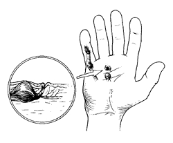 250x207 Dupuytren's Contracture Disease And Treatment Houston