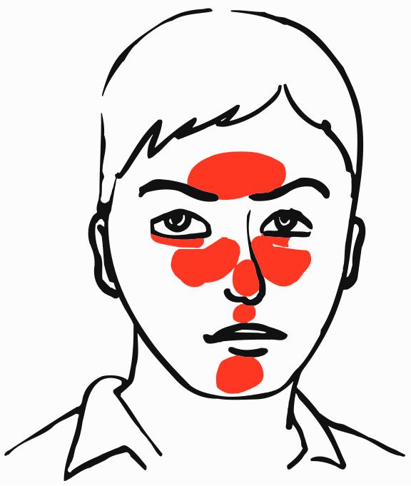 576x681 Causes Of Redness Around Eyes