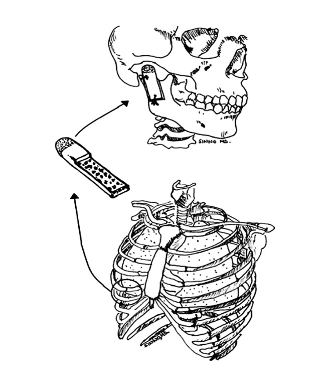 656x735 Drawing Of The Harvest Of The Costochondral Rib Graft