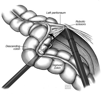 367x330 Robotic Abdominoperineal Resection