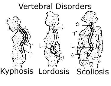 367x286 Difference Between Lordosis And Kyphosis Scoliosis