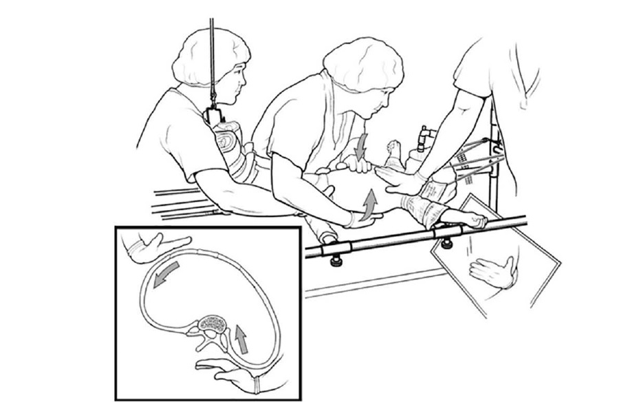 922x597 Infantile Idiopathic Scoliosis