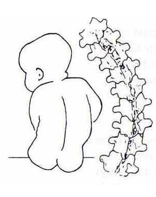 305x384 Infantile Scoliosis