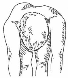 236x273 Rib Hump In Scoliosis Of 2 Degrees