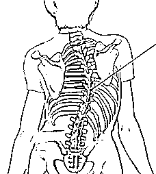 228x254 Scoliosis