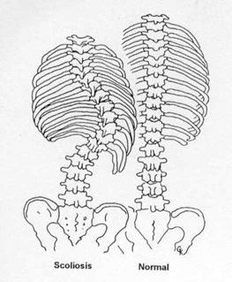 263x319 Scoliosis Info Next Book Scoliosis, Scoliosis