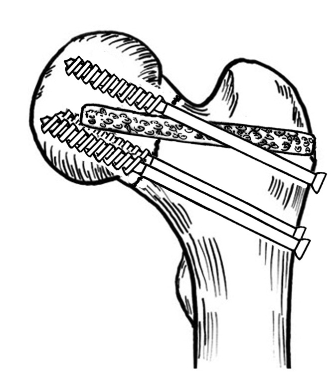 664x755 A Drawing Of The Relative Position Of The Iliac Bone Block Graft