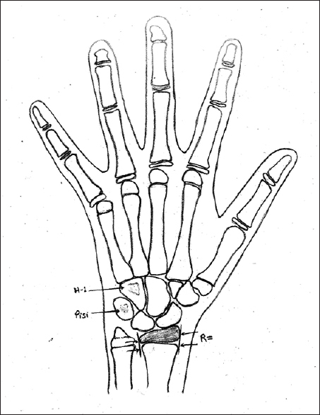 453x586 Evaluation Of Skeletal Maturity In North Indian Subjects Using