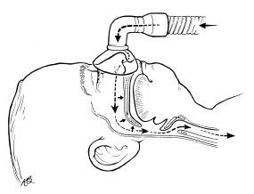 285x218 Obstructive Sleep Apnea (Osa)