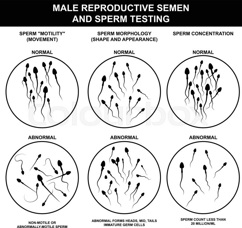 800x756 Spermogram And Semen Parameters, Oligozoospermia