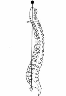 230x334 Scoliosis Curves Measurements Bone And Spine
