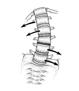 257x296 Spinal Scoliosis