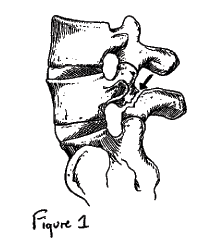 200x250 Spondylolysis And Spondylolysthesis