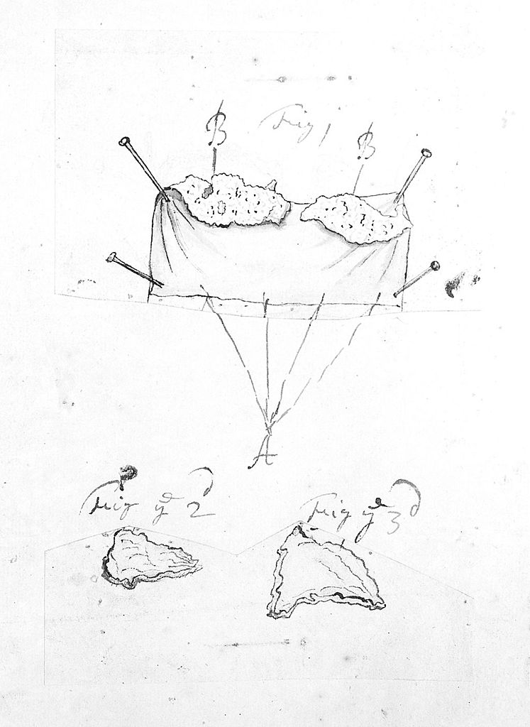 747x1024 Filedrawings By Cheselden Including Chalk Stones. Wellcome