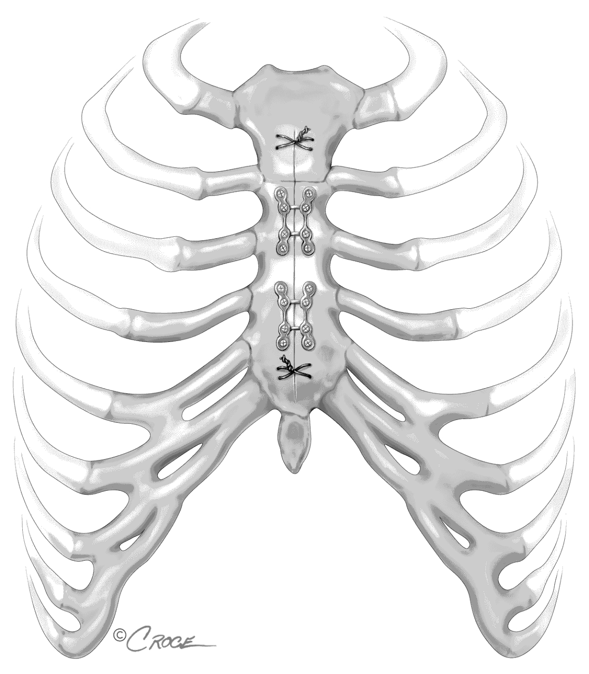 1188x1358 Painless Cardiac Surgery
