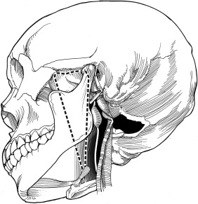 282x291 Surgical Management Of Vagal Paraganglioma