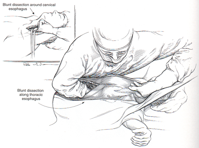 690x515 Transhiatal Esophagectomy Surgery 101