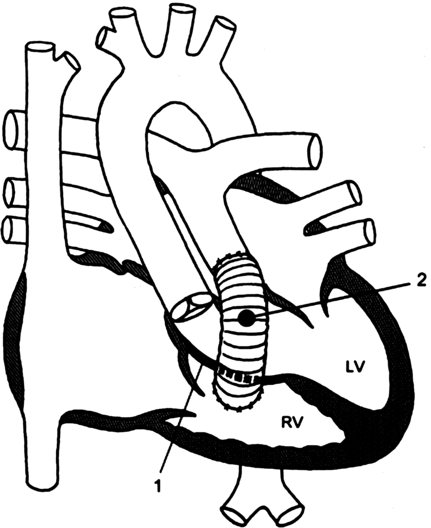 1469x1800 Transposition Of The Great Arteries Circulation