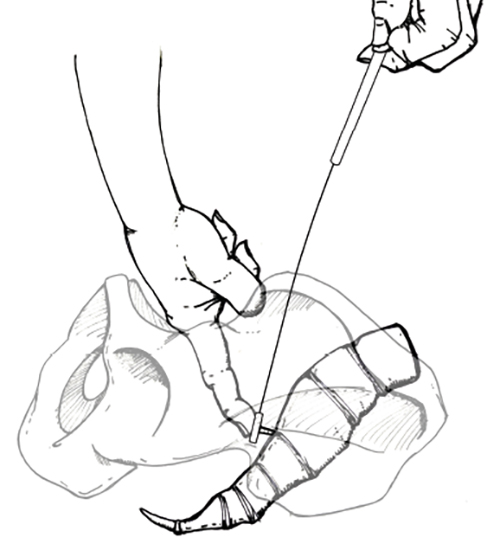 500x544 Hemorrhage Occluder Pin