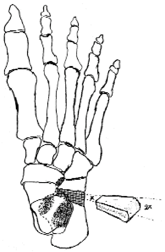 561x855 Drawing Of The Osteotomy And The Trapezoid Graft.