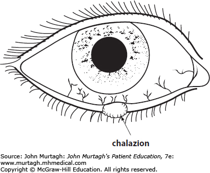 413x342 Eye Disorders John Murtagh's Patient Education, 7e Murtagh