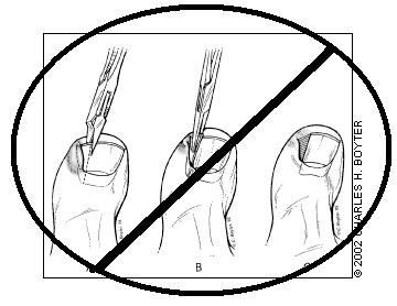 360x278 Ingrown Toenails Is Simple Wedge Resection Obsolete Pain