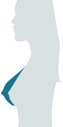 220x440 Breast Augmentation