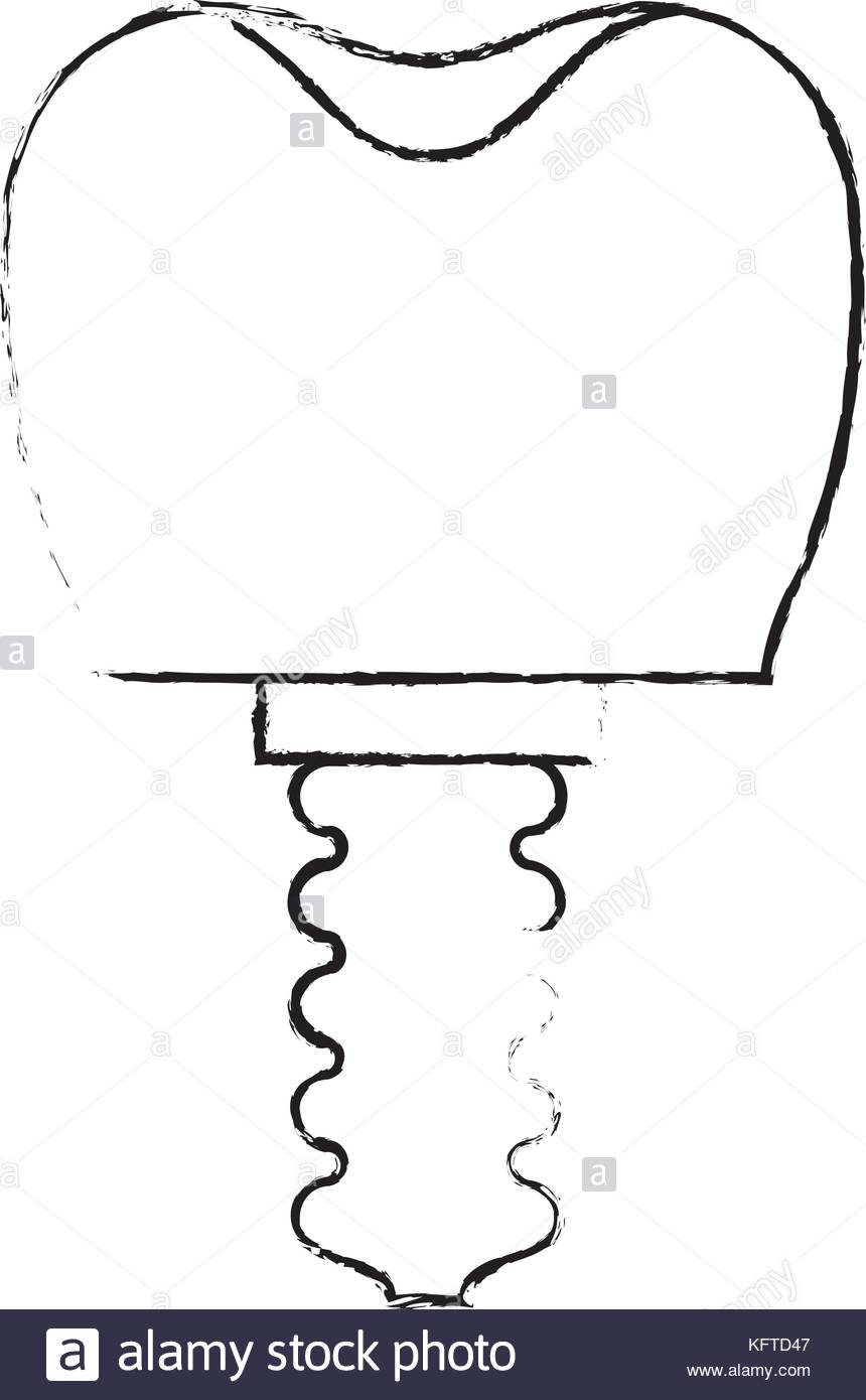 860x1390 Tooth Implant With Screw In Monochrome Blurred Silhouette Stock