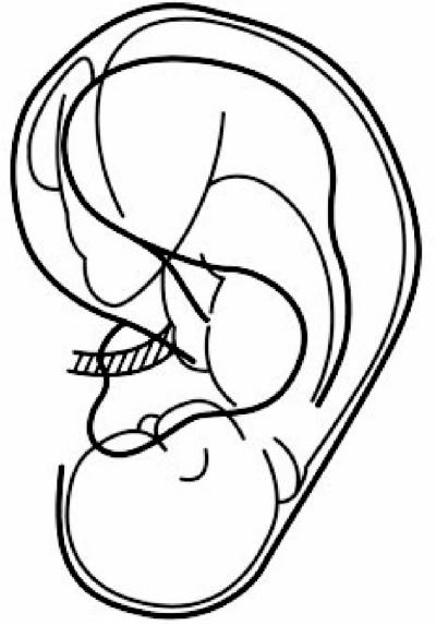 400x573 This Drawing Illustrates The Concept Of An Inverted Fetus Map