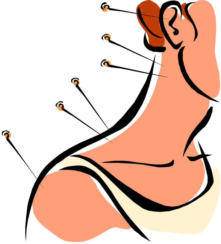 750x827 The Benefits Of Acupuncture Acupuncture