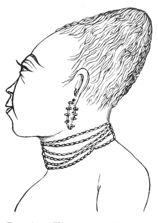 536x755 Frontiers Of Anthropology Artificial Cranial Deformation In