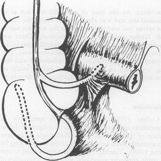 320x320 Pdf) Appendix Vermiformis Duplex