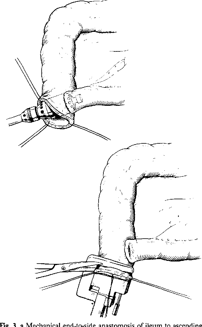 674x1088 Figure 3 From The Mainz Pouch (Mixed Augmentation Ileum