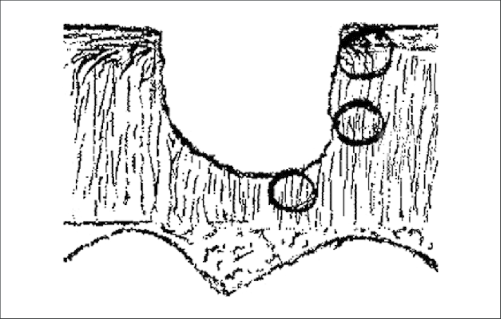 711x453 Drawing Depicting A Partial Thickness Cartilage Injury