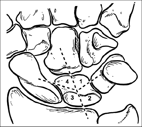 499x445 Drawing Shows Lunate Was Divided In Four Regions To Determine