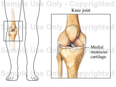 400x300 The Medial Meniscus Cartilage
