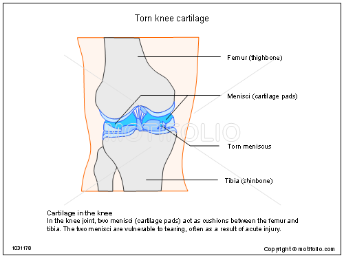 500x375 Torn Knee Cartilage Illustrations