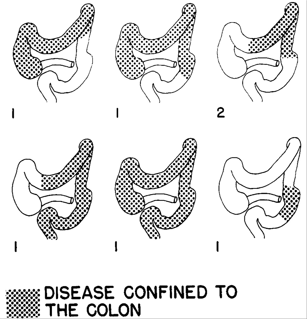1200x1249 Granulomatous Colitis A Clinical Study Nejm