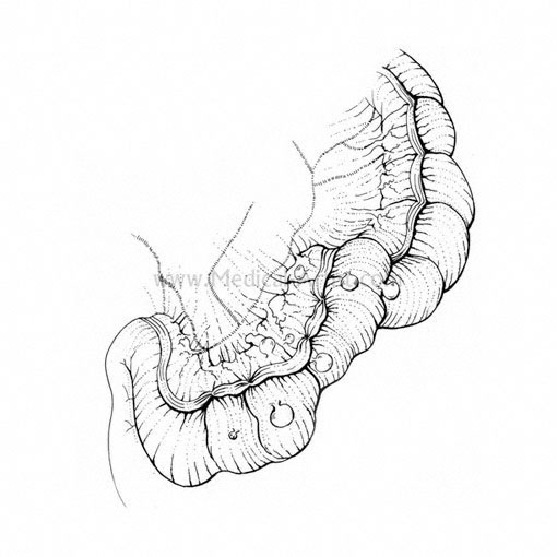 510x510 Sigmoid Colectomy Surgical Sequence Medical Illustration Pen