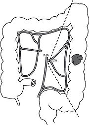 180x254 Colorectal Cancer And Adenoma