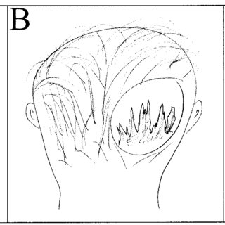 320x320 Examples Of Symptomatic, Nonmigraine Headaches. A, A 10 Year Old