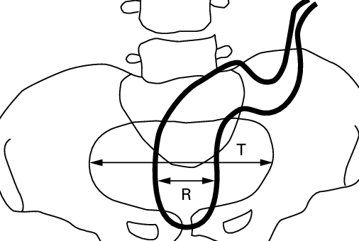 506x340 Determination Of The Rpr. The Maximal Pelvis Diameter (Linea