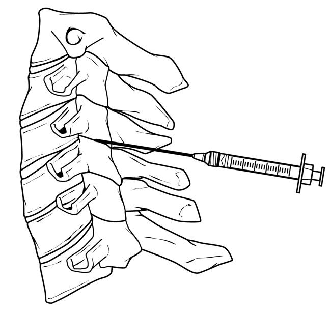 650x613 Cervical Radiculopathy (Pinched Nerve)